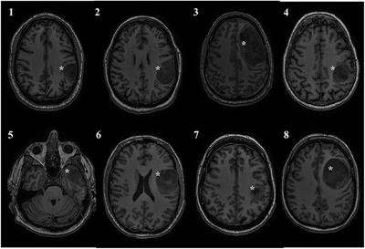 Preoperative Transcranial Direct Current Stimulation in Glioma Patients: A Proof of Concept Pilot Study